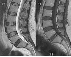 LEAKING DISC SYNDROME - Center for Pain Management