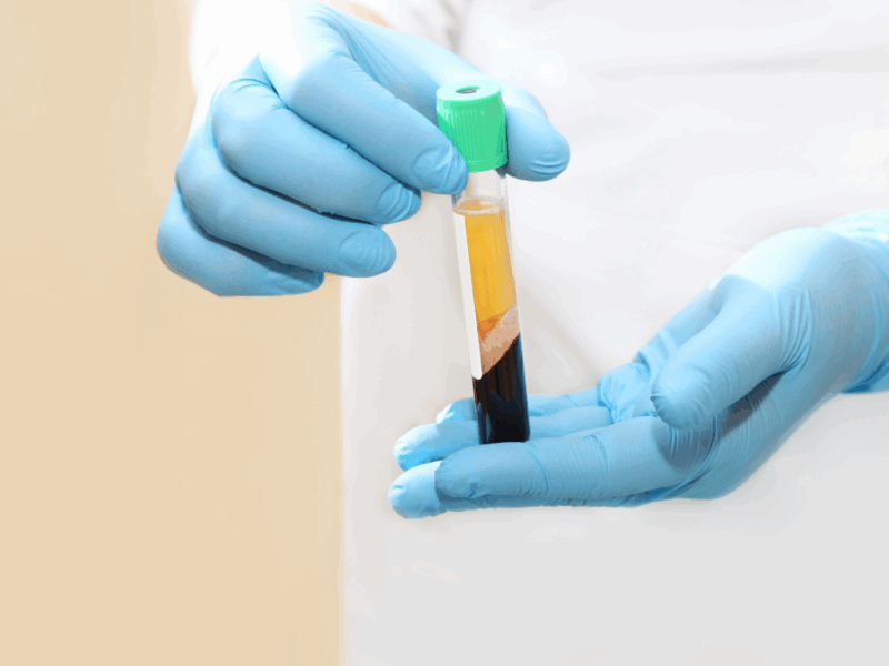 PRP and Bone marrow concentrate