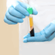 PRP and Bone marrow concentrate