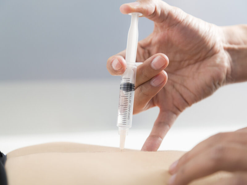 prolotherapy